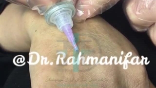 درمان چروک های دست با دستگاه پزشکی Carboxy Therapy