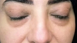 بهترین درمان برای پف زیر چشم  -  دکتر محمد یوسفوند