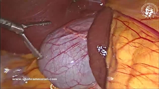 قرارگیری کیسه صفرا در سمت چپ کبد