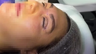 بلفاروپلاستی در کلینیک گونه