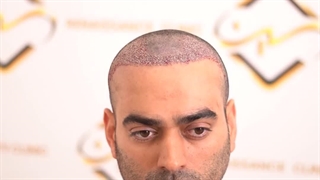 کاشت موی طبیعی رنسانس