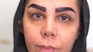 کاشت ابرو بدون جراحی به روش sut