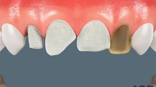 افزایش ماندگاری کامپوزیت دندان