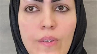 کاشت ابرو با خواب ابروی کاملا طبیعی