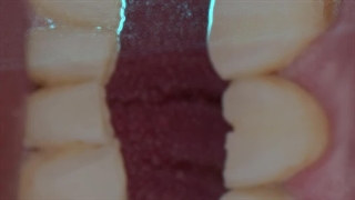 بازسازی فانکشن و زیبایی به وسیله درمان ترکیبی ایمپلنت،لمینت و روکش های سرامیکی