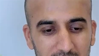 کاشت موی طبیعی به روش سوپر sut