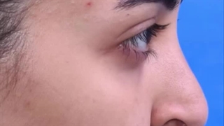 رینوپلاستی در تهران با بهترین نتیجه