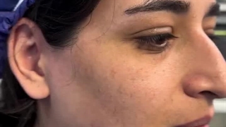 عمل رینوپلاستی با کم ترین کبودی