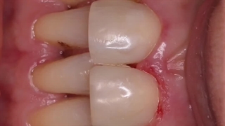 کامپوزیت دندان