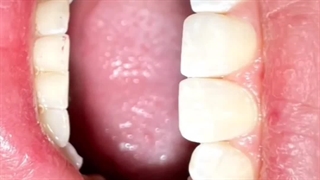 چسب دندان؟!