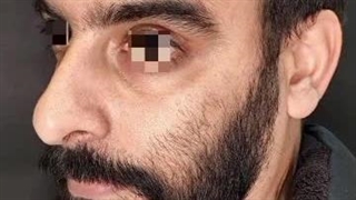 بلافاصله پس از جراحی بینی آقا