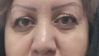 کاشت ابرو در کلینیک آوینا