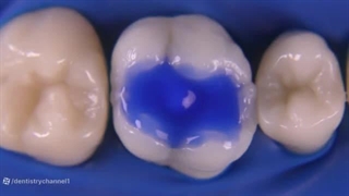 مهم‌ترین مراحل آماده‌سازی دندان قبل از باندینگ یا ترمیم چیست؟