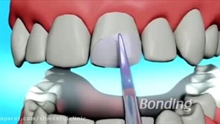 باندینگ دندان چیست و در چه مواردی استفاده می‌شود؟