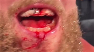 ویدیو جیک پال از فک شکسته‌اش در مبارزه با آنتونی جاشوآ