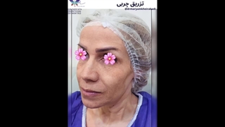 نمونه‌ای از تزریق چربی به صورت (7)