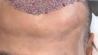 کاشت مو به روش sut در کلینیک رنسانس