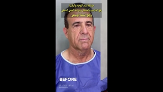 مراجعه کننده جراحی لیفت صورت و گردن از لس آنجلس