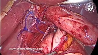 عمل جراحی نیسن با فلپ شل دور مری