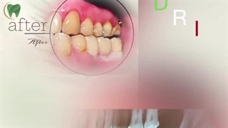 ایمپلنت ایرانی با قیمت مناسبتر