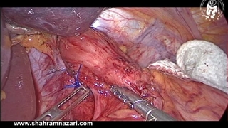 رسیدن به طول کافی مری داخل شکمی و ترمیم متناسب کرورال در ترمیم فتق هیاتال با لاپاروسکوپی