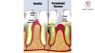 تغییر رنگ لمینت در افراد سیگاری