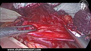 نتیجه نهایی میوتومی هلر به روش لاپاراسکوپی: جداسازی کافی عضله و نمایان شدن مخاط