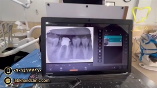 همه چیز درباره درمان ریشه دندان (عصب‌کشی)