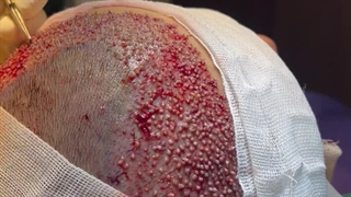 کلینیک تخصصی کاشت مو آفتاب ۰۹۱۳۳۶۹۱۲۸۹