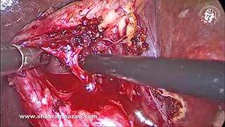 تشریح لاپاراسکوپی در کیسه صفرای فیبروتیک مزمن: دستیابی به دیدگاه حیاتی ایمنی