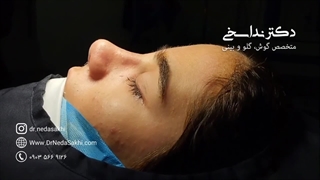 بلافاصله پس از عمل بینی