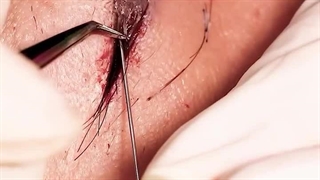 کاشت فولیکول ابروها از زاویه نزدیک در کلینیک آفرینش