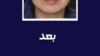 تغییری زیبا فقط با یک سی سی فیلر برای لب مراجعه کننده عزیزمون