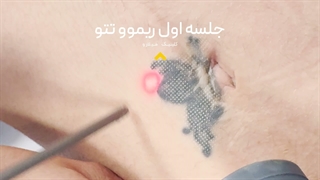 ✨ ریموو تتو با جدیدترین تکنولوژی لیزر