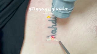 ✨ ریموو تتو با جدیدترین تکنولوژی لیزر