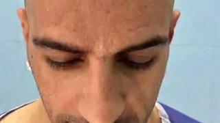 کاشت مو شقاقی در مشهد