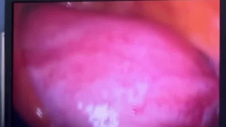ببین سزارین با رحمش چیکار کرده!