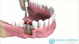 کاشت دندان یا ایمپلنت چگونه انجام می‌شود؟