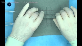 10 Principles of Plastic Surgery - Scar Lengthening
