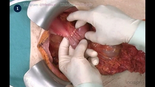 11 Bowel Anastomosis - Jejuno-jejunostomy (Brauns)