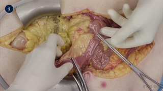 12 Bowel Anastomosis - Side-to-Side Stapled