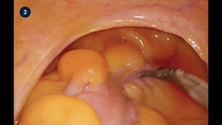 20 Laparoscopic Low Anterior Resection (LLAR)