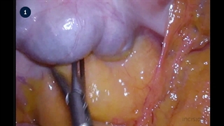 23 Laparoscopic Right Colectomy - Medial to Lateral