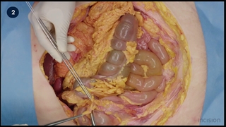 29 Omental plasty