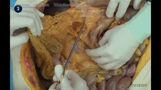 32 Open Distal Pancreatectomy