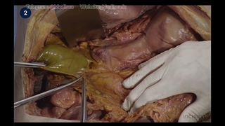 49 Open Retrograde Cholecystectomy