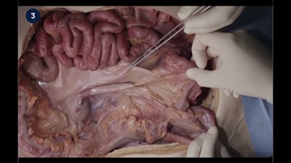 51 Open Right Colectomy - Medial to Lateral