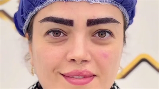 با کاشت ابرو قاب چشمهات رو زیباتر کن